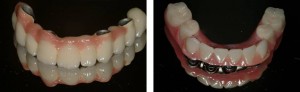 Full mouth rehab with implants